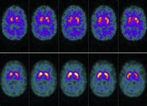 False-Positive DaTscan Features With Methylphenidate and Phentermine Therapy - Mayo Clinic ...