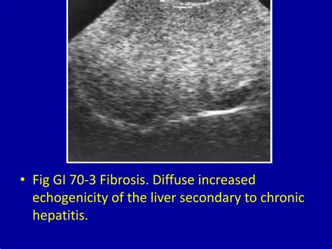 70 generalized increased echogenicity of the liver | PPT