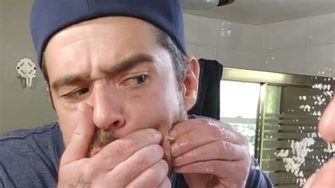 Image result for Exploding Zit Videos 2013