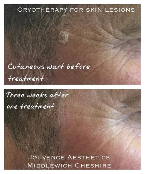 Seborrhoeic keratosis/wart removal at Cheshire Lasers, Middlewich