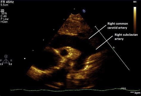 Double Aortic Arch with Atresia versus Interruption of Proximal Left Arch: Prospective ...