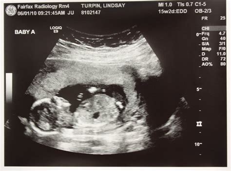 Adventures in Baby Making: 16 Weeks Ultrasound Pics