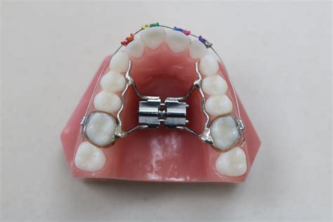 Palatal Expander - Village Orthodontics & Minneapolis Orthodontics | Minneapolis New Brighton MN