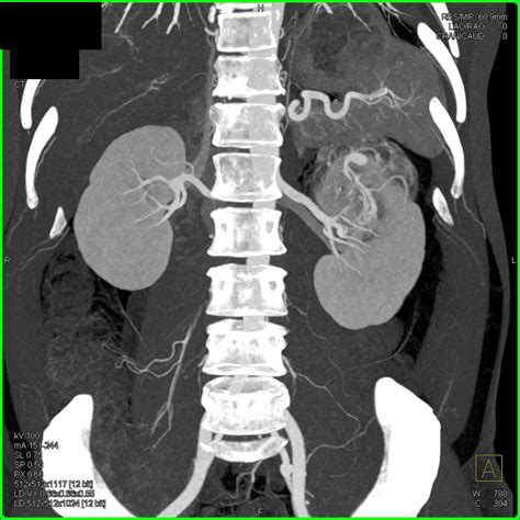 Clear Cell Renal Cell Carcinoma (RCC) with Neovascularity - Kidney ...