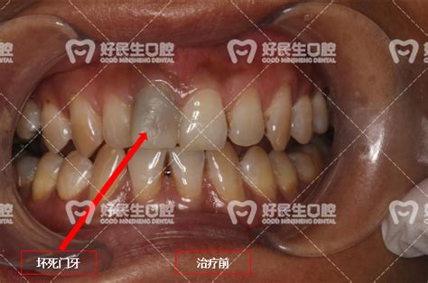 北京朝阳区牙科诊所的多颗种植牙案例合集,缺牙的你要看么