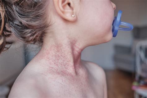 Newborn Rash On Neck And Chest at Robert Parsley blog