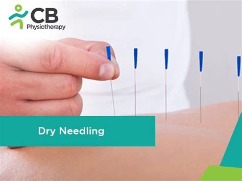Dry Needling Therapy Near Me in Bangalore | Book Appointment / Consult ...