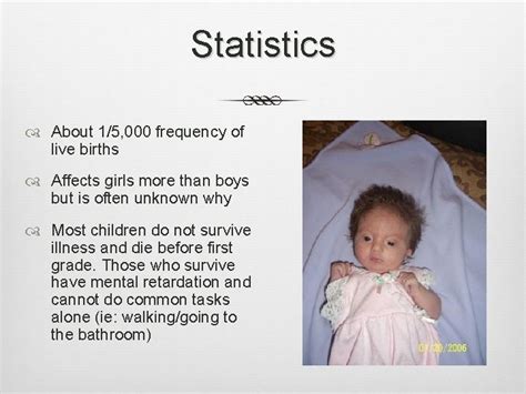 Edwards Syndrome Madeline Zachman and Tina *** Characteristics