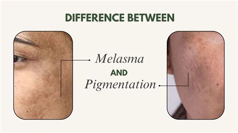 Difference between melasma and pigmentation | Hyperpigmentation vs. Melasma | Melasma and ...