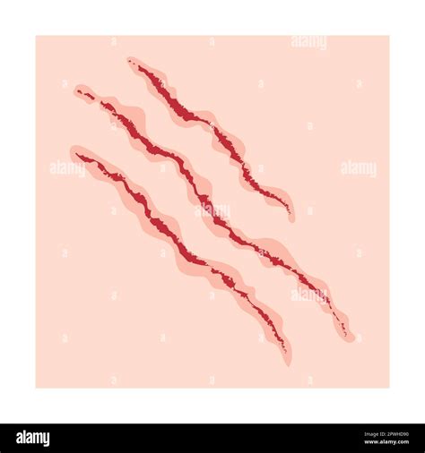 Scar with stitches cartoon illustration. Bloody wound, injures, scratches, bruises, surgical ...