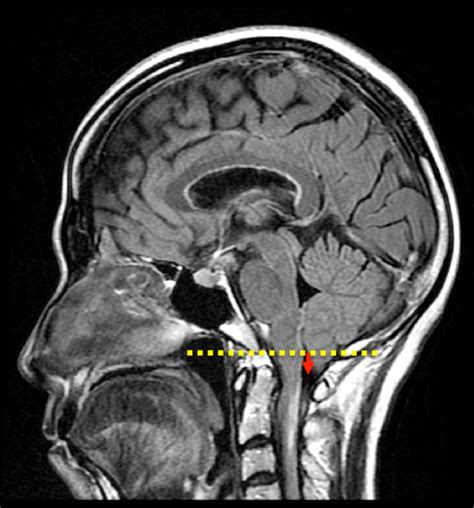 Cerebellar Tonsils Mri