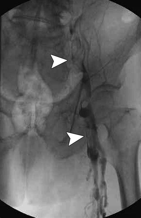 Comprehensive MDCT Evaluation of Patients With Suspected May-Thurner ...