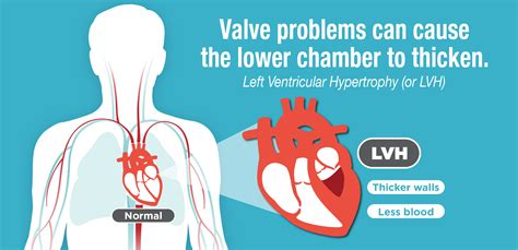 What is Left Ventricular Hypertrophy (LVH)? | American Heart Association