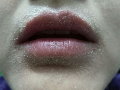 【嘴唇过敏的原因】【图】嘴唇过敏的原因 应该如何对抗唇炎_伊秀健康|yxlady.com