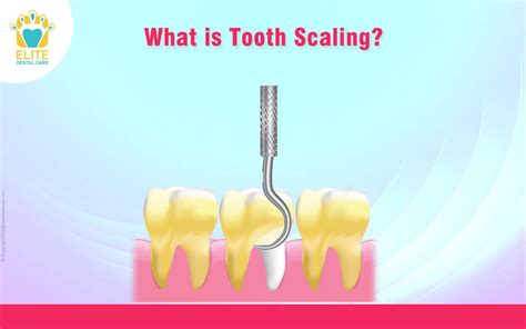 What is Tooth Scaling? - Elite Dental Care