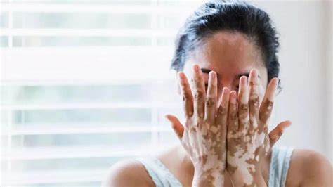 Vitiligo impacts more than appearance: Here’s how it affects mental and ...
