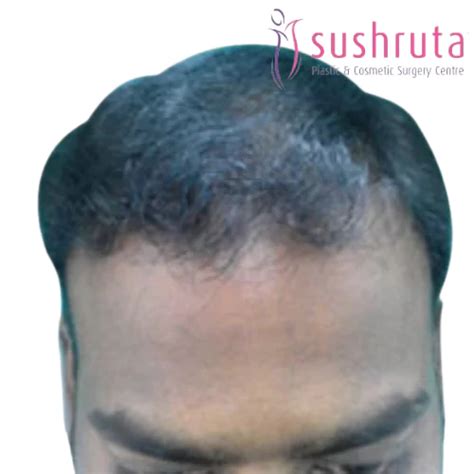 Before and after pictures of Sushruta Cosmetic & Plastic Surgery