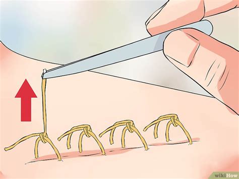 Removing Sutures Step by Step 的图像结果