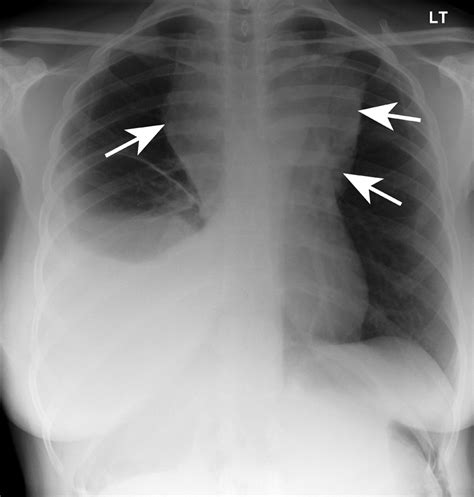 X Ray Pregnancy