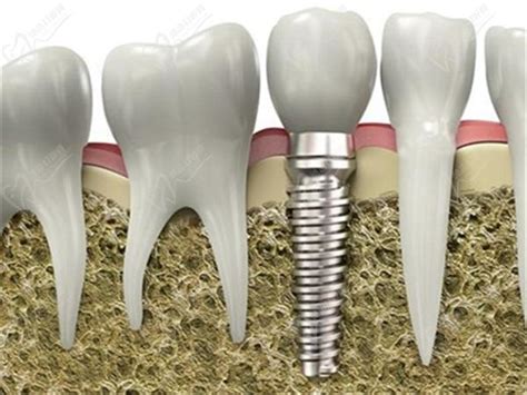 种植牙齿之前需要具备的几个条件 | 升艺口腔医院