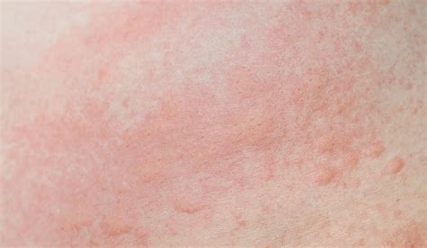 Self-Care Tips To Prevent Heat Rash In Singapore - Epi Dermatology ...