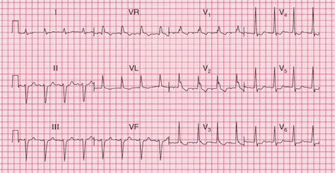 Image result for AFib Detection Algorithm