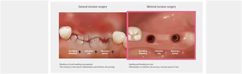 Future is Here: “Digital Implants” What, Why and How?
