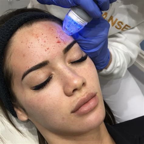 Vampire Lift – Experia Advanced Skin & Hair Clinic