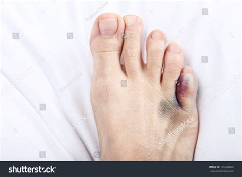 1,291 Bruised toe Images, Stock Photos & Vectors | Shutterstock