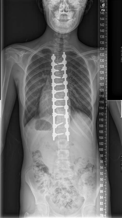 Escoliosis, ¿qué es?¿cómo se trata? - Instituto Cirugía de Columna