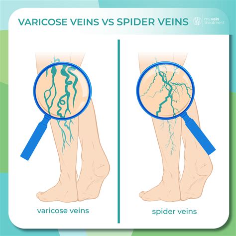Varicose Veins vs. Spider Veins: What’s the Difference?
