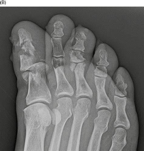 Distal Phalanx Fracture Toe