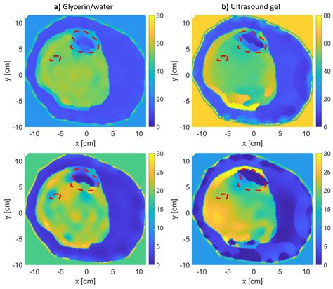 Monitoring Bone Density Using Microwave Tomography of Human Legs: A ...