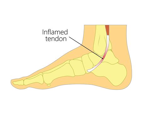 Posterior Tibial Tendon