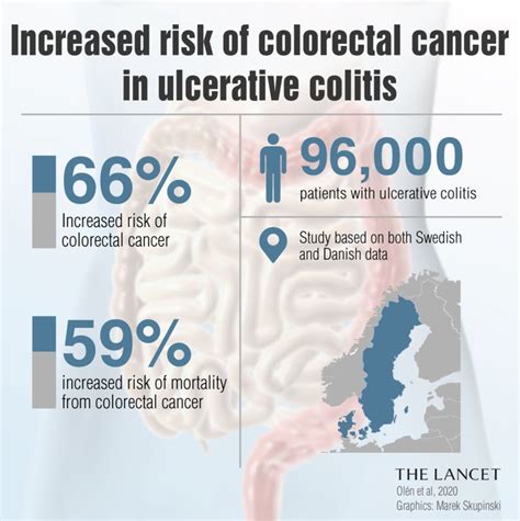 Colitis Vs. Cancer 的图像结果