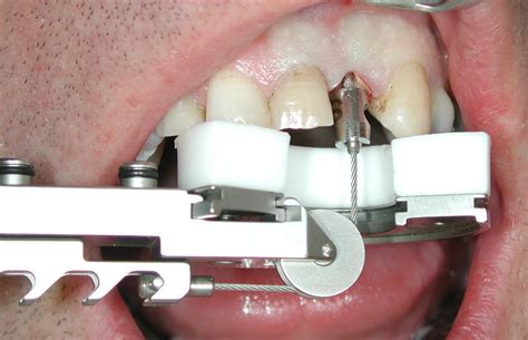 Tooth Extraction Equipment 的图像结果