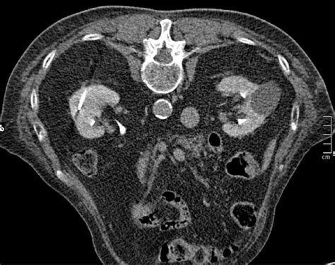 Ablative Verfahren in der Behandlung von Nierentumorerkrankungen ...