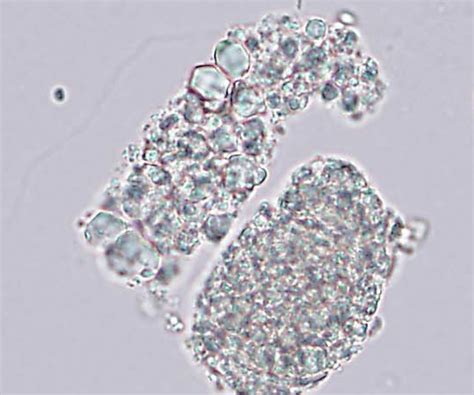 Urinary casts containing crystals in light chain proximal tubulopathy ...