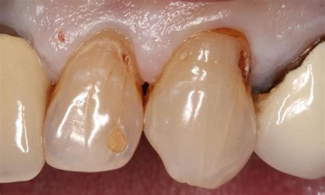 Image result for Discolored Tooth