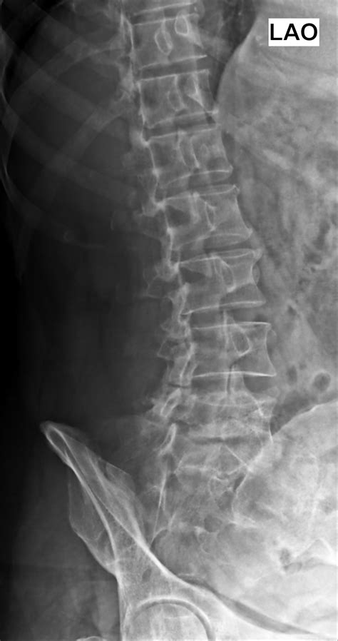 Grade 1 Spondylolisthesis L5 S1