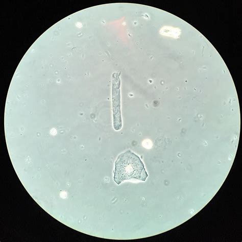 Hyaline Cast Urine