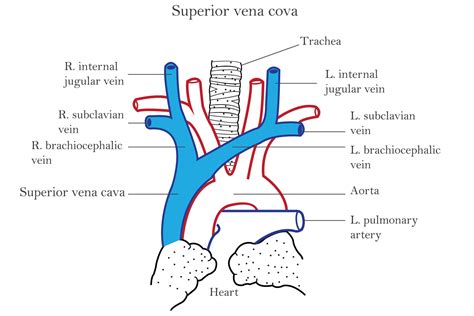 Superior Vena Cava Filter
