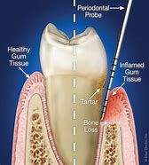 periodontal 的图像结果