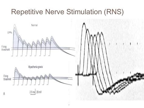 Image result for Repetitive Nerve Stimulation Test