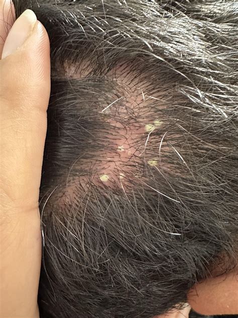 Scalp pimple, i don’t know why i am getting this and how to cure it : r ...