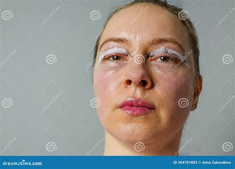 Woman Face after Plastic Surgery, Blepharoplasty Operation, Swelling Eye Bags, Incisions with ...