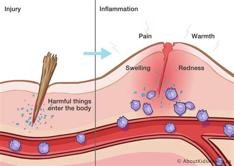 Inflammation Process Steps 的图像结果