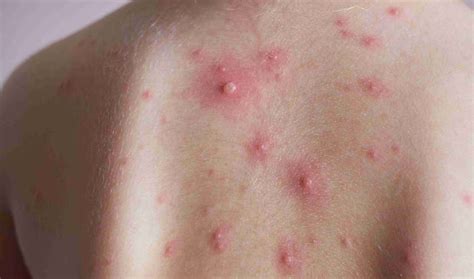 Why do Indians call chicken pox 'Mata', know the reason behind it