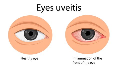 What is Uveitis, What Causes Uveitis, Uveitis Symptoms