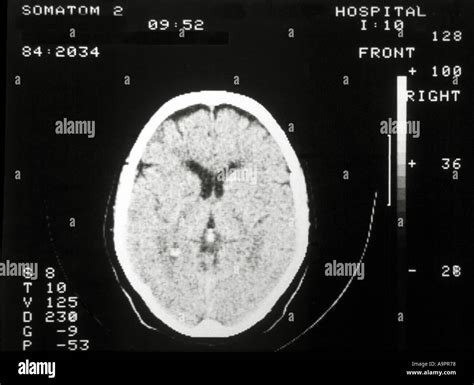 Normal brain scan hi-res stock photography and images - Alamy